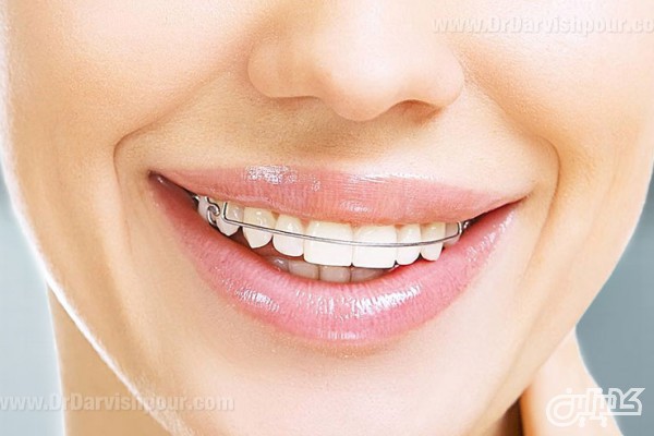اورتودنسی نامرئی در مرکز تخصصی